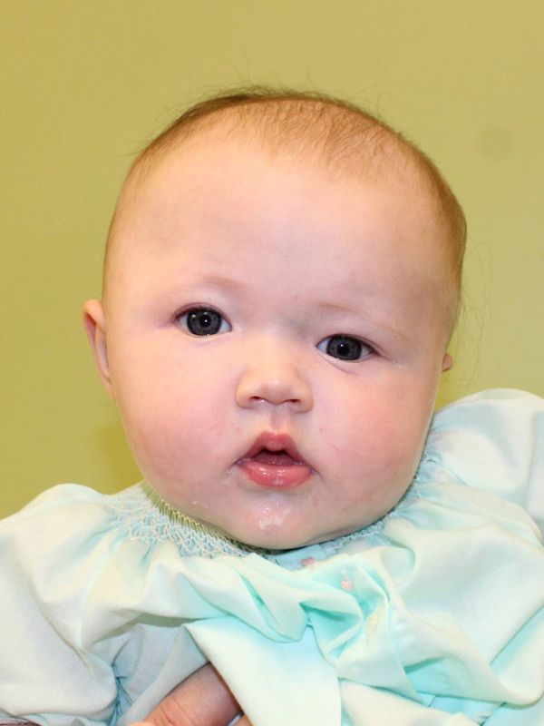 A baby with craniosynostosis before surgery